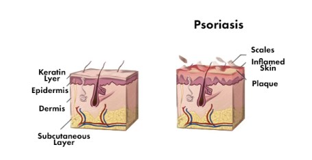 psoriasis-skin-structure